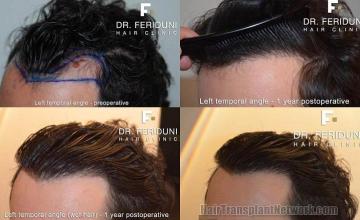 Hair restoration surgery before and after photos