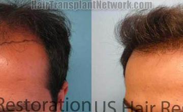 Hair transplantation surgery before and after images