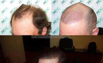 Hair restoration procedure before and after pictures