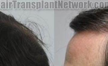 Hair transplantation surgery before and after photos