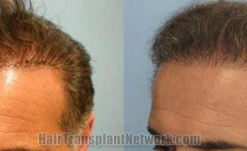 Hair restoration procedure before and after results