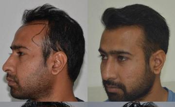 Hair transplantation surgery before and after images