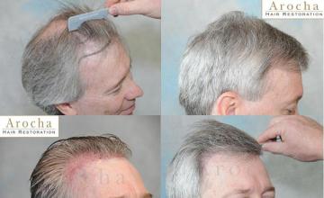 Right view before and after hair transplant procedure