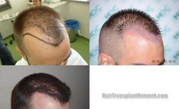 Hair transplantation surgery before and after images