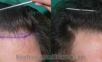 Hair transplantation surgery before and after images