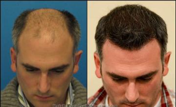 Hair transplantation surgery before and after photos