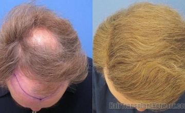 Photos of  top view showing hair restoration results