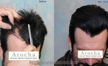 Before and after hair transplant procedure images