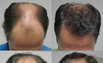 Top view before and after hair restoration results