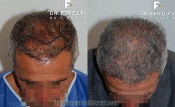 Hair transplantation surgery before and after photos