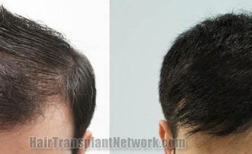 Hair transplantation surgery before and after photos