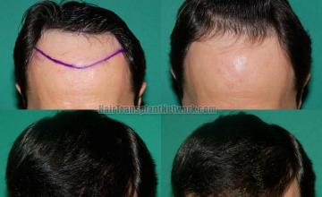 Hair restoration procedure before and after results