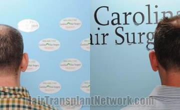 Hair restoration procedure before and after pictures