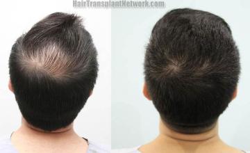 Hair restoration procedure before and after pictures