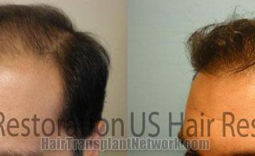 Left view images before and after hair transplantation