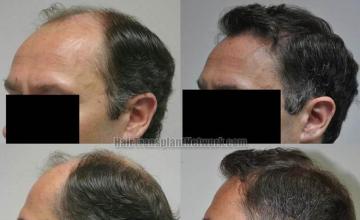 Before and after hair transplantation result photographs