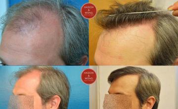  before and after photos