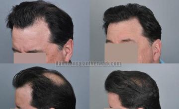 Hair transplantation surgery before and after pictures