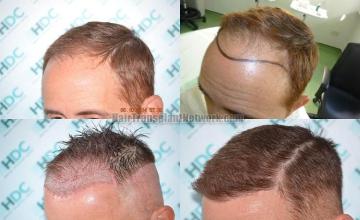 Hair transplantation surgery before and after pictures