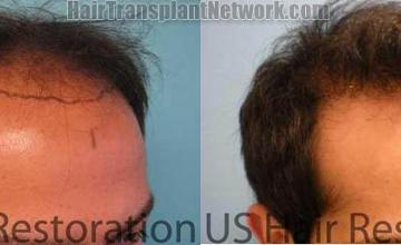 Hair restoration procedure before and after results