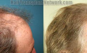 Hair transplantation surgery before and after photos