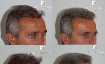 Hair transplantation surgery before and after images