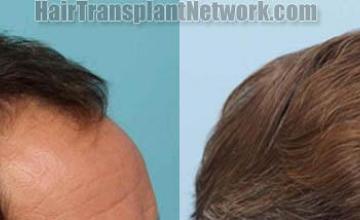 Hair transplantation surgery before and after images