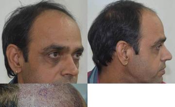 Hair transplantation surgery before and after images