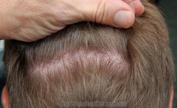 Residual scar one year after hair transplant