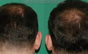 Hair restoration surgery before and after images