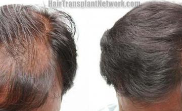 Top view before and after hair restoration results