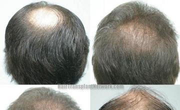 Hair restoration procedure results