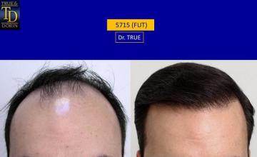 Hair restoration procedure before and after results