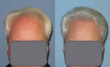 Before and after hair transplant procedure images
