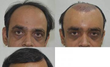 Before and after hair transplant procedure images