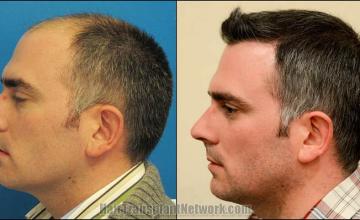 Hair restoration procedure before and after pictures