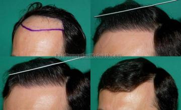 Hair transplantation surgery before and after images