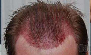 Before and after hair restoration procedure results