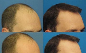 Right views showing before and after photos from hair restoration