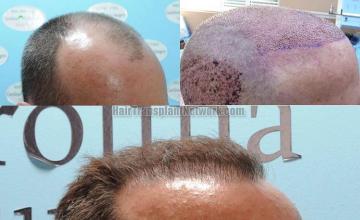 Hair restoration procedure before and after results