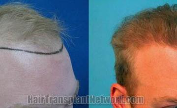 Hair transplantation surgery before and after photos