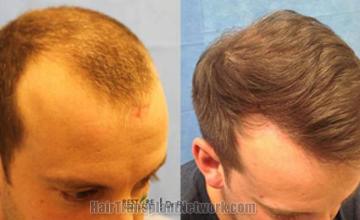 Hair transplantation surgery before and after pictures