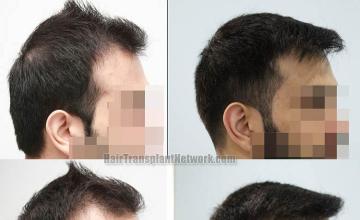 Hair transplantation surgery before and after images