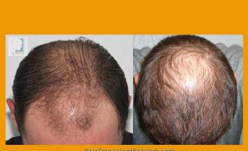 Hair transplantation surgery before and after photos