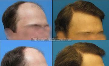 Hair restoration procedure before and after results