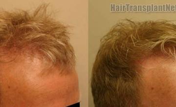 Hair transplantation surgery before and after photos