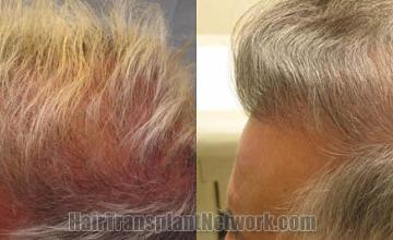Hair restoration procedure before and after results