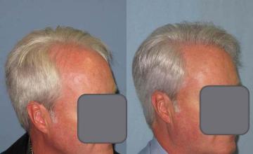 Hair transplantation surgery before and after photos