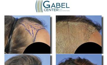 Hair restoration procedure before and after pictures