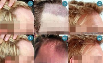  before and after images